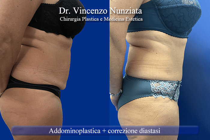 addominoplastica roma 4