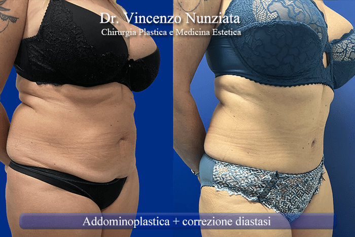addominoplastica roma 5