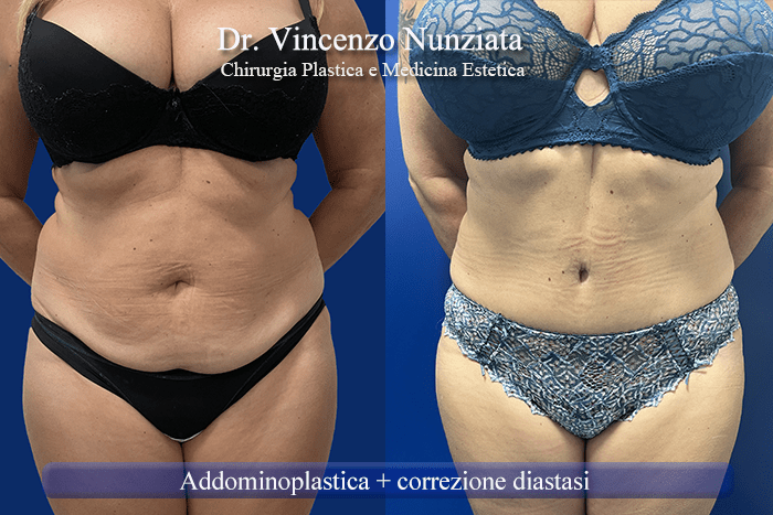 addominoplastica roma