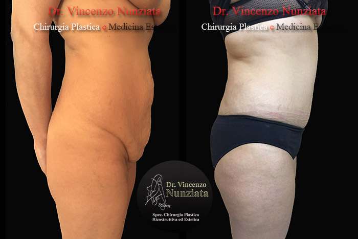 addominoplastica vibo2