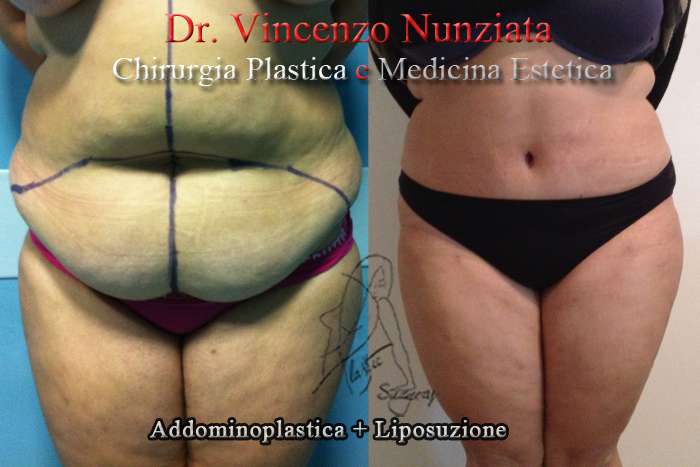 addominoplastica 2 frontale