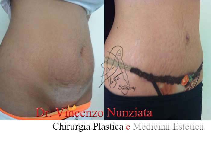 addominoplastica 3 3 4 dx