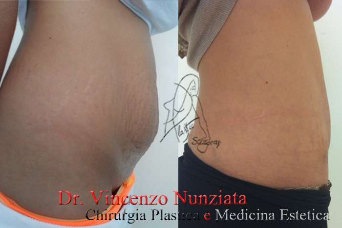 addominoplastica 3 dx