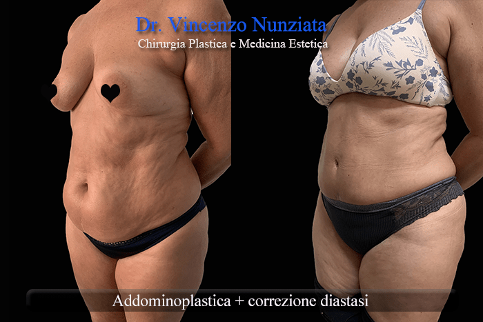 diastasi calabria2