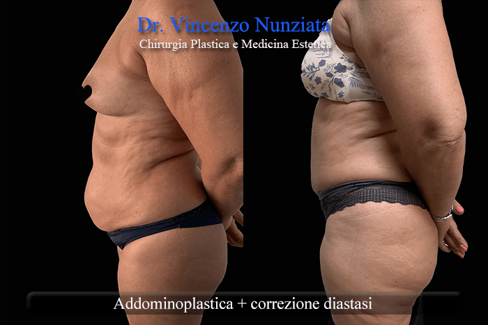 diastasi calabria3