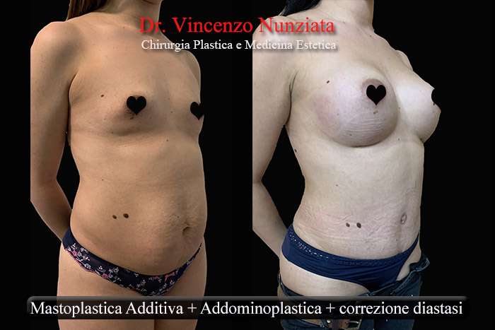 mommy makeover calabria 2web