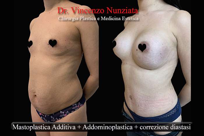 mommy makeover calabria 3 web