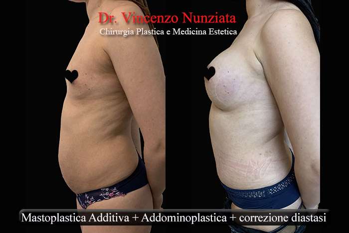 mommy makeover calabria 3web